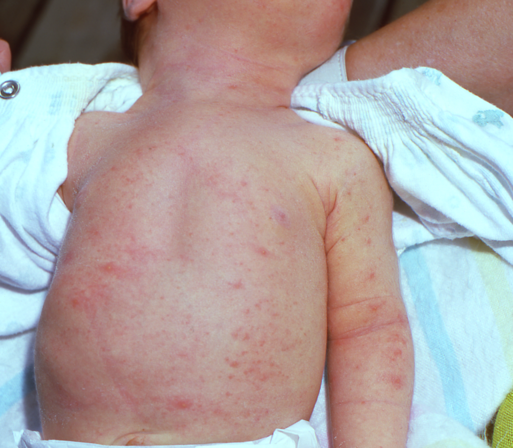 Common Newborn Rashes Pediatrics West