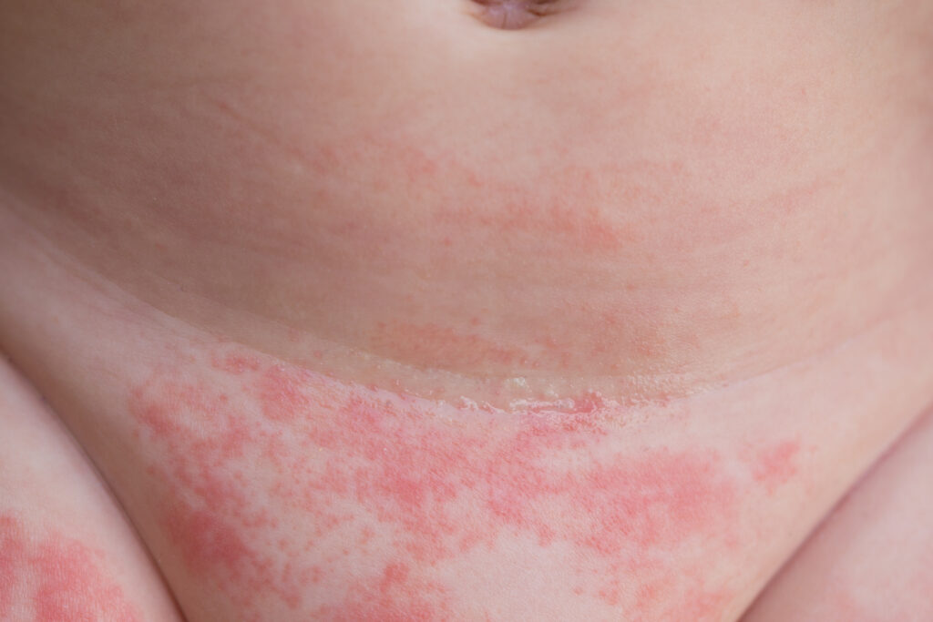 Red bumps/rash on breasts - pics included - January 2023 Babies